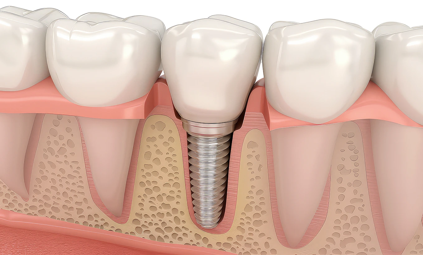 ¿Cuáles son las ventajas de las prótesis fijas sobre implantes sobre las prótesis removibles?