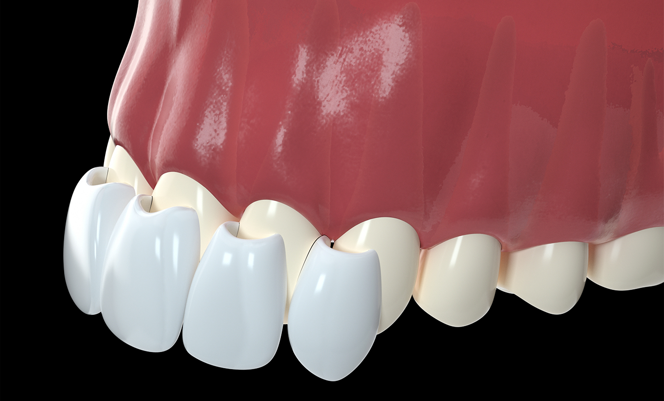 ¿Qué son las carillas dentales de cerámica?