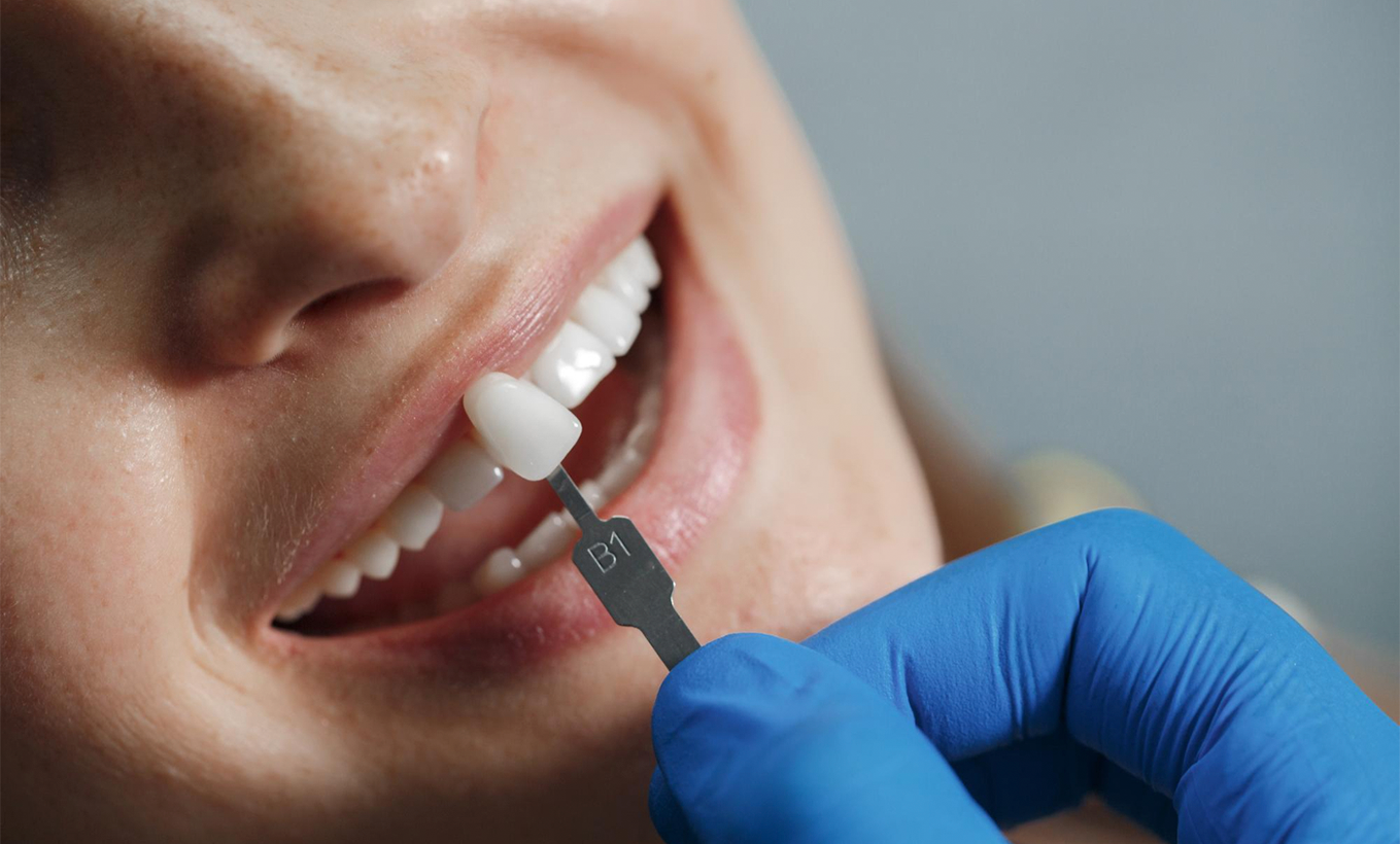 ¿Qué cuidados debo tener después de la instalación de un implante dental?