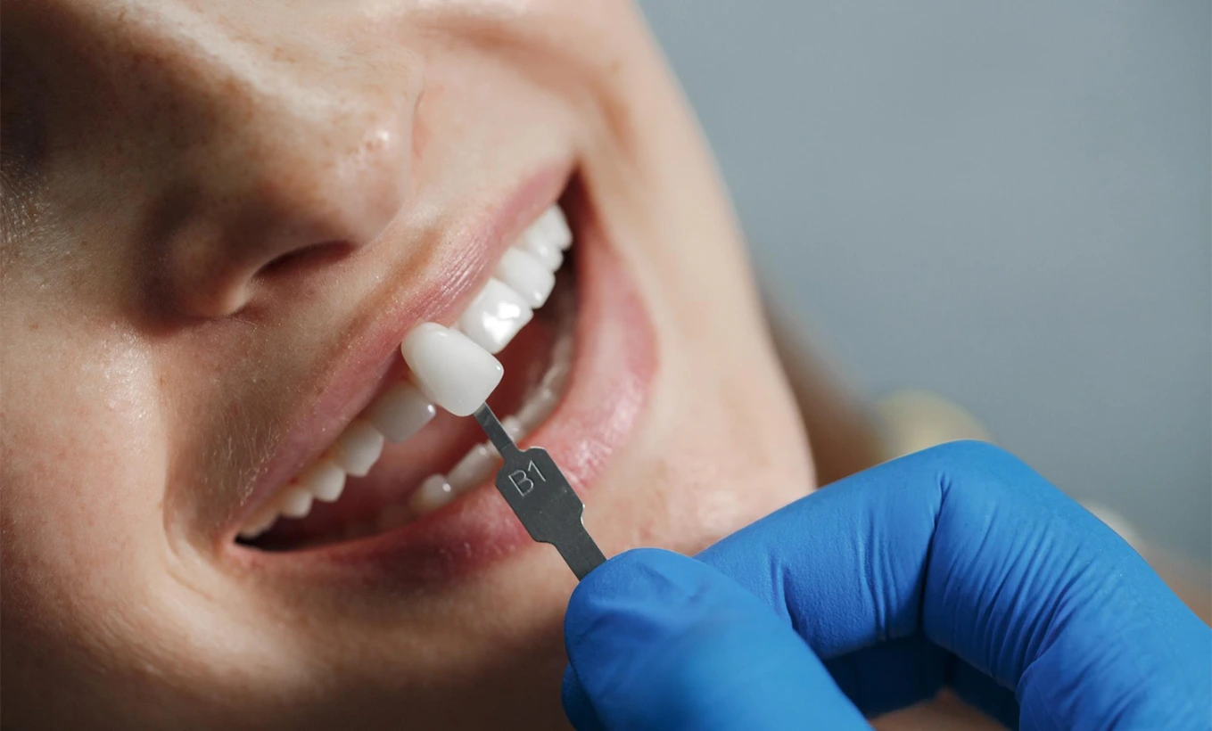 ¿Qué cuidados debo tener después de la instalación de un implante dental?